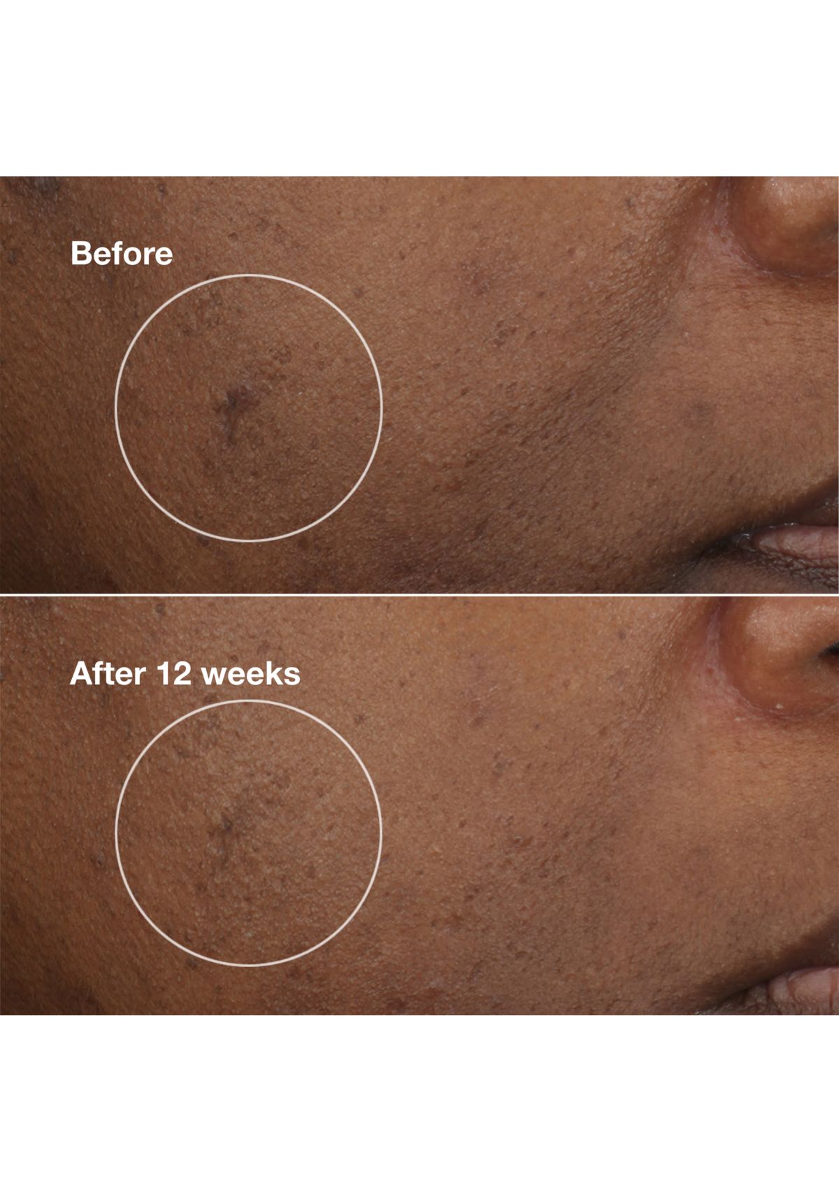 Even Better Clinical™ Brightening Moisturizer