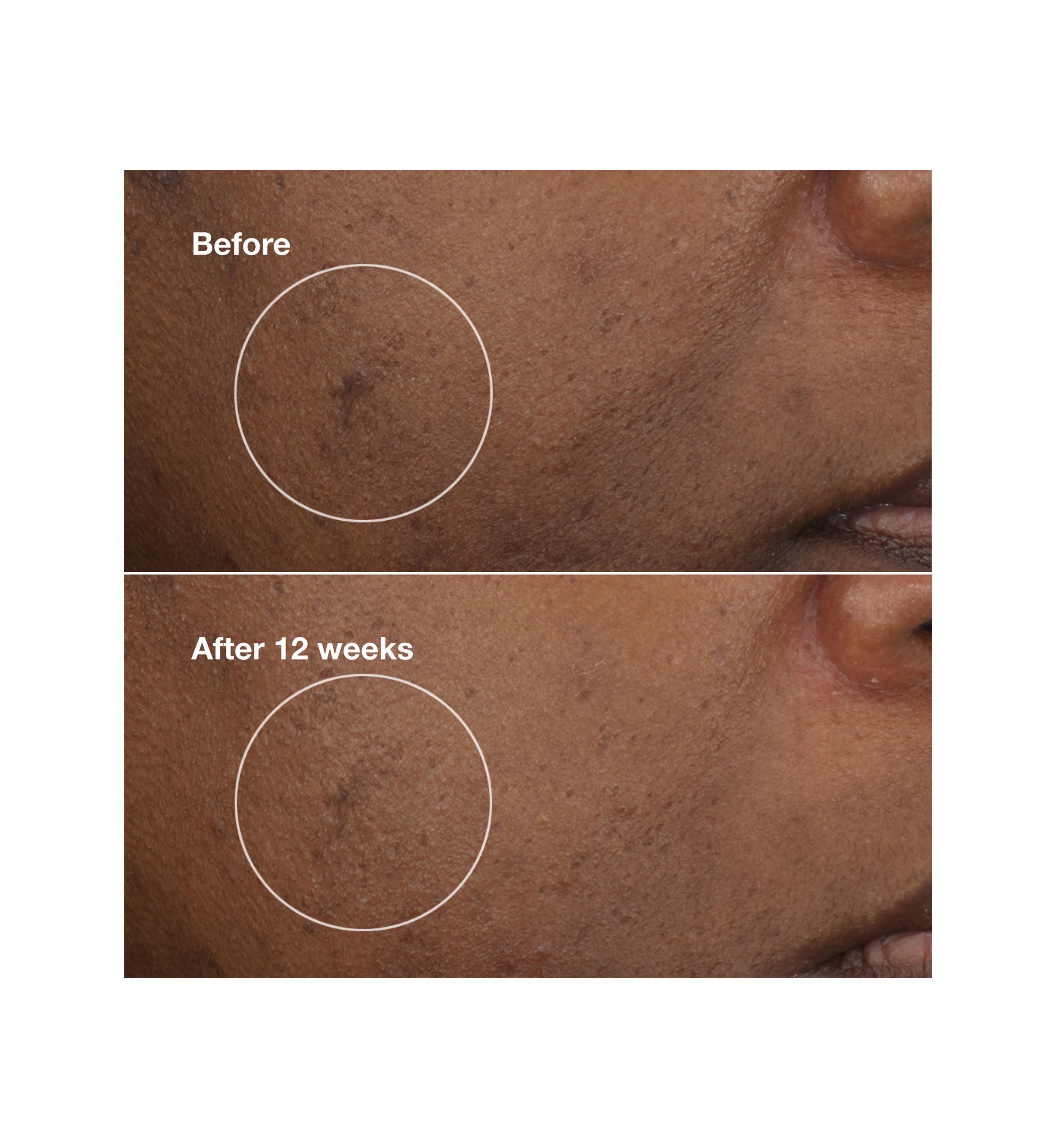 Even Better Clinical™ Brightening Moisturizer