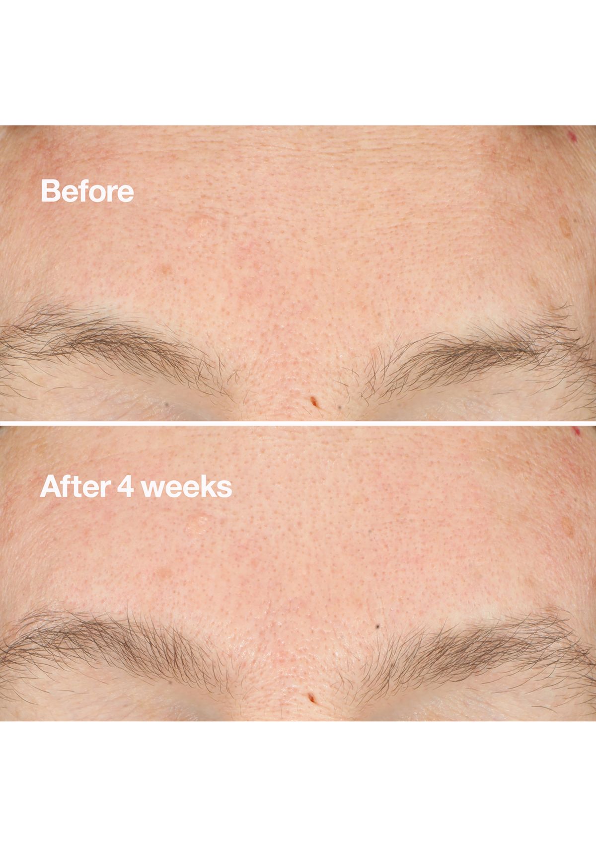 Clarifying Do-Over Peel