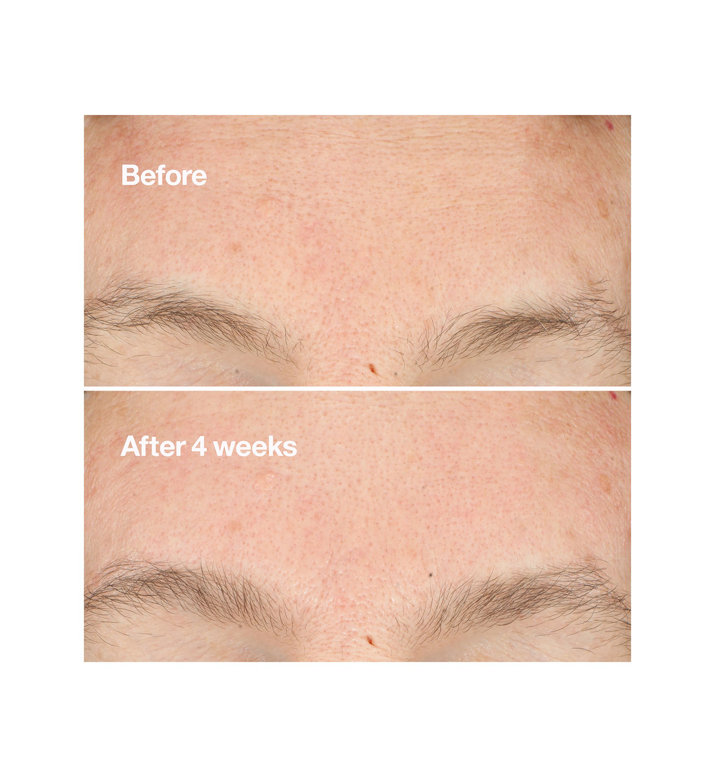 Clarifying Do-Over Peel