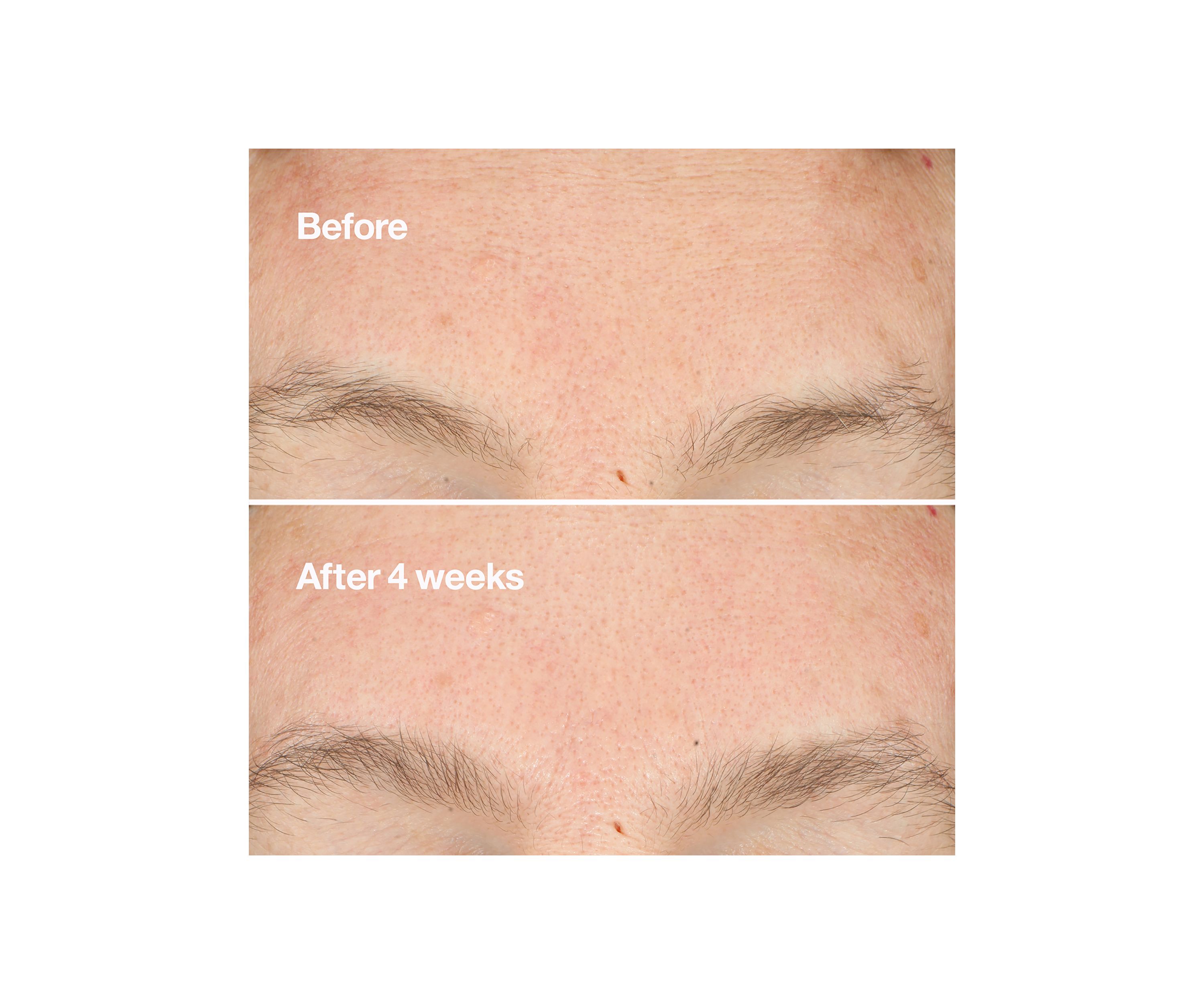 Clarifying Do-Over Peel