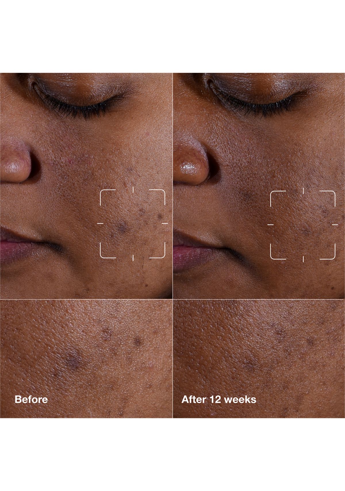 Even Better Clinical™ Dark Spot Clearing Serum with Vitamin C 