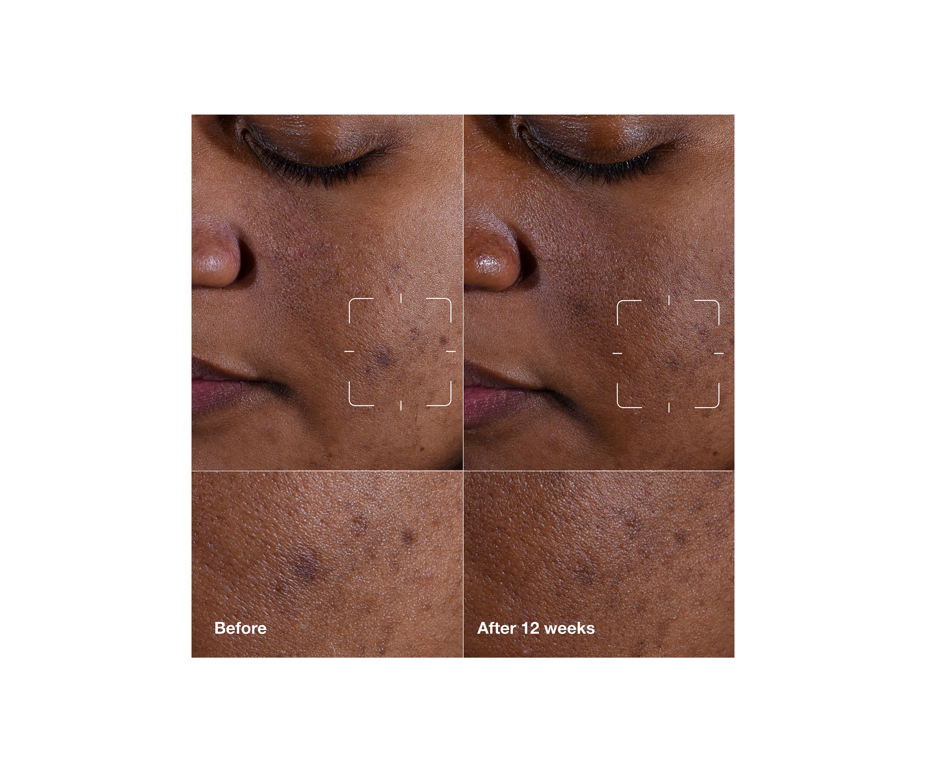 Even Better Clinical™ Dark Spot Clearing Serum with Vitamin C 