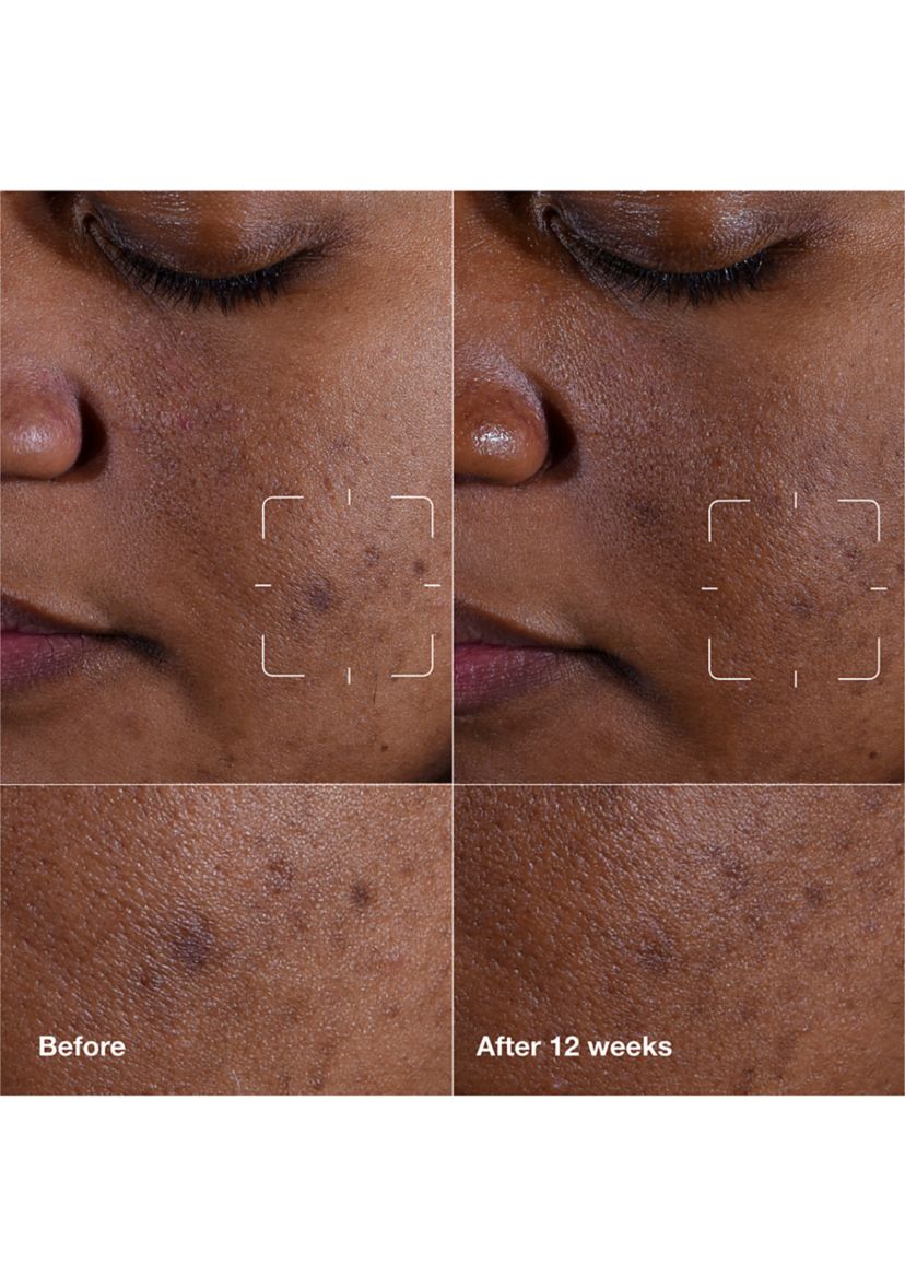 Even Better Clinical™ Dark Spot Clearing Serum with Vitamin C 