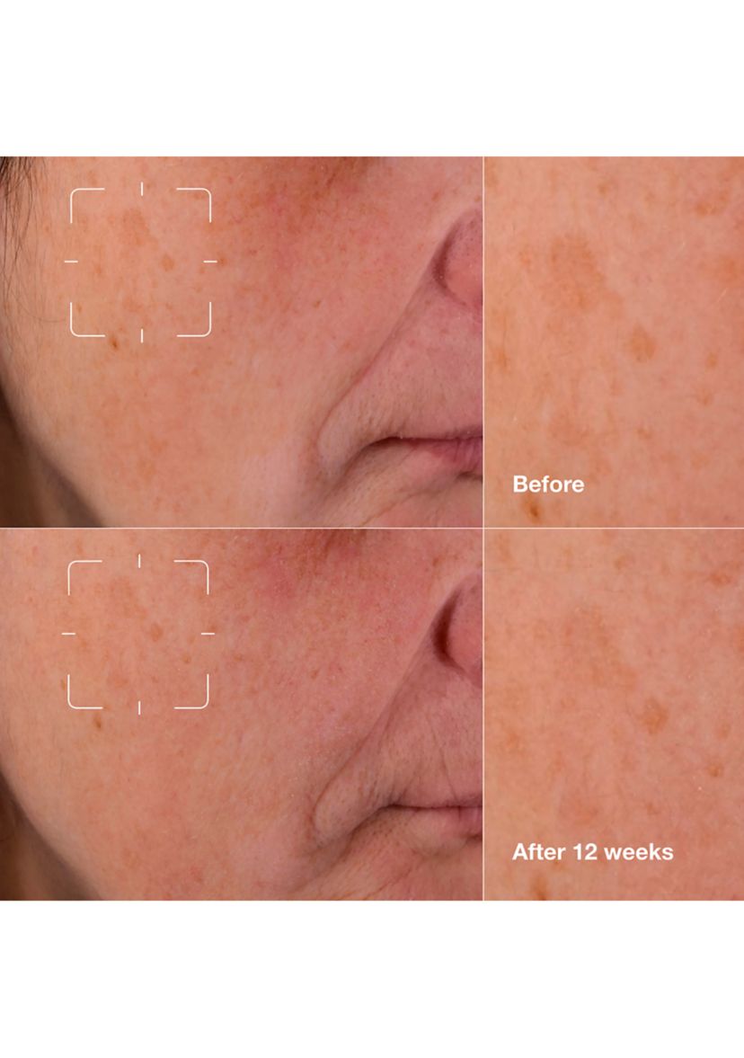 Even Better Clinical™ Dark Spot Clearing Serum with Vitamin C 