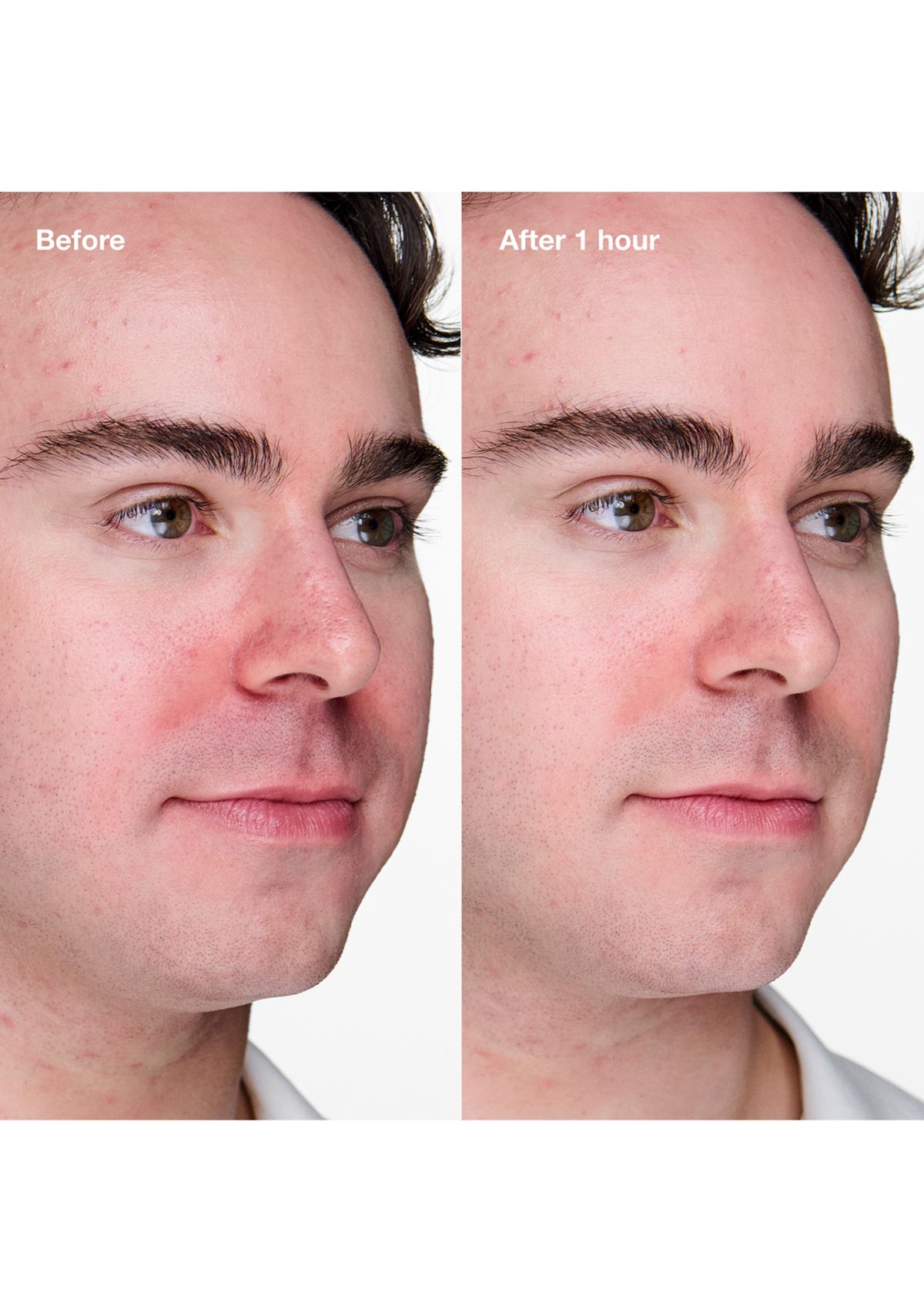 Acne Solutions Clinical Advanced Clearing Gel with Salicylic Acid