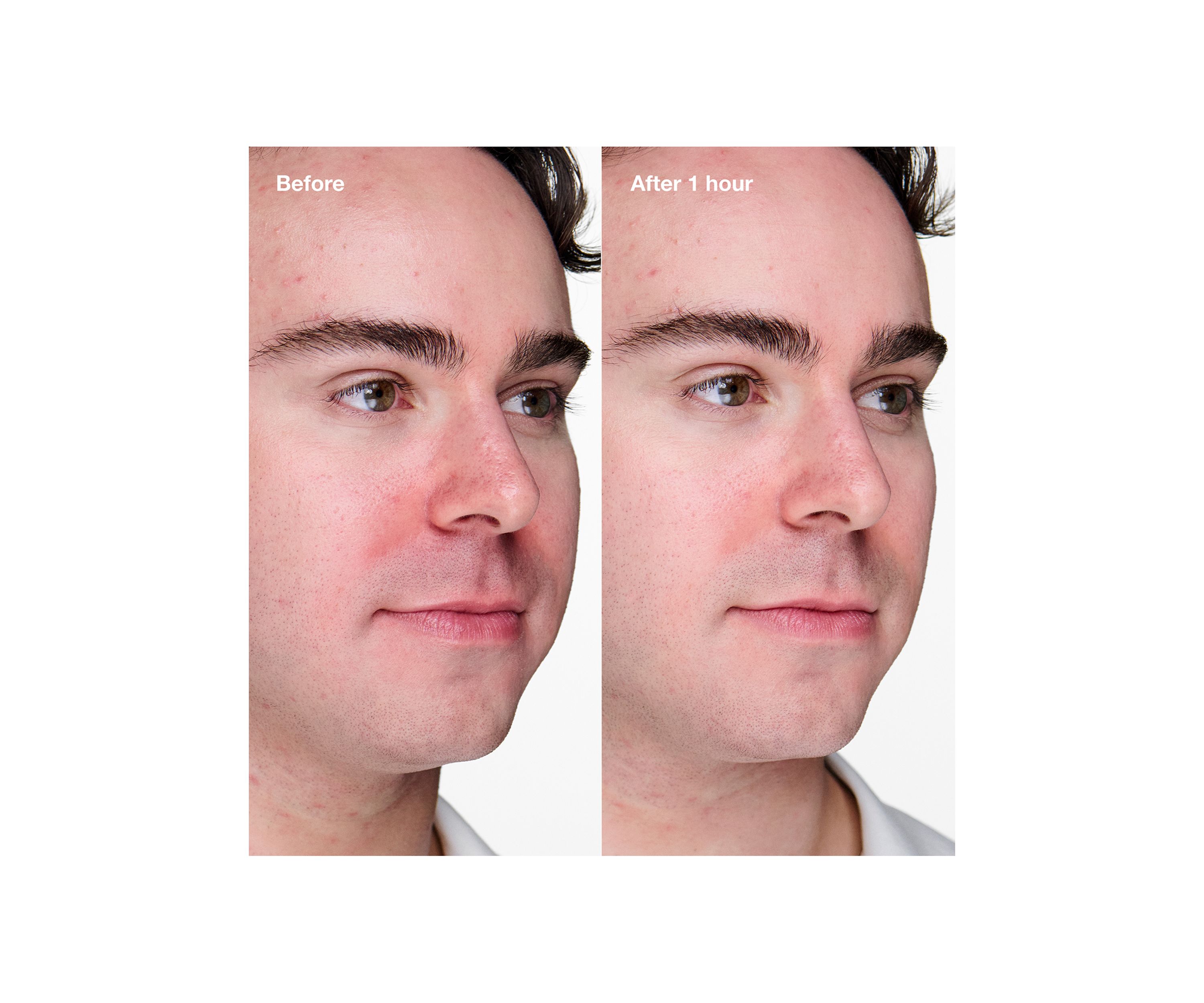 Acne Solutions Clinical Advanced Clearing Gel with Salicylic Acid