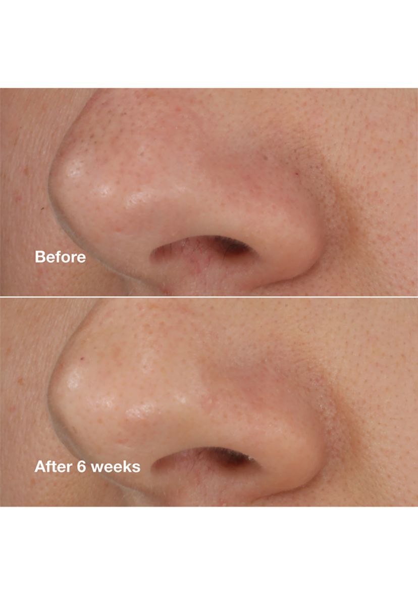 Blackhead Solutions Self-Heating Blackhead Extractor