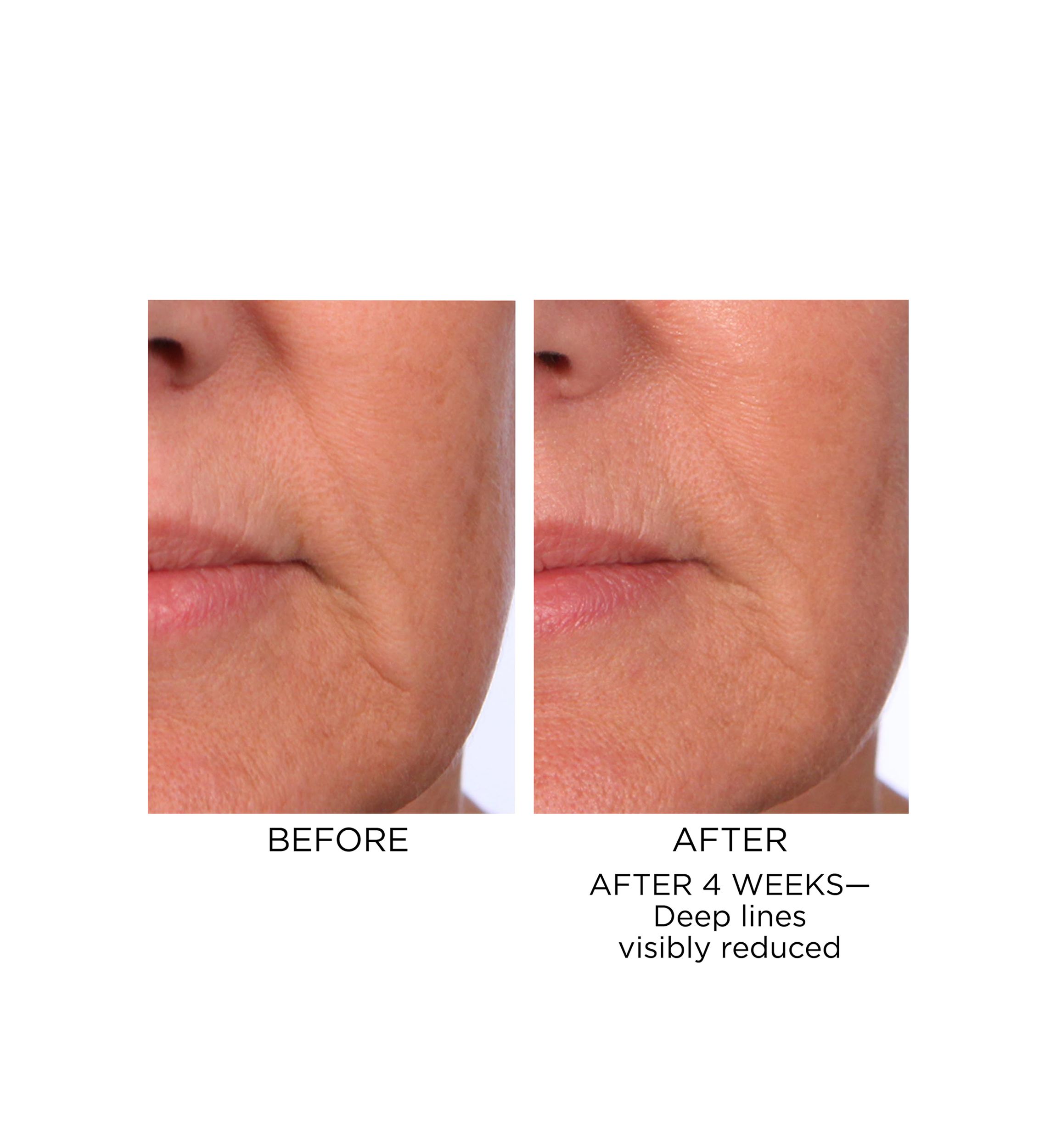 Prevage Progressive Renewal Treatment