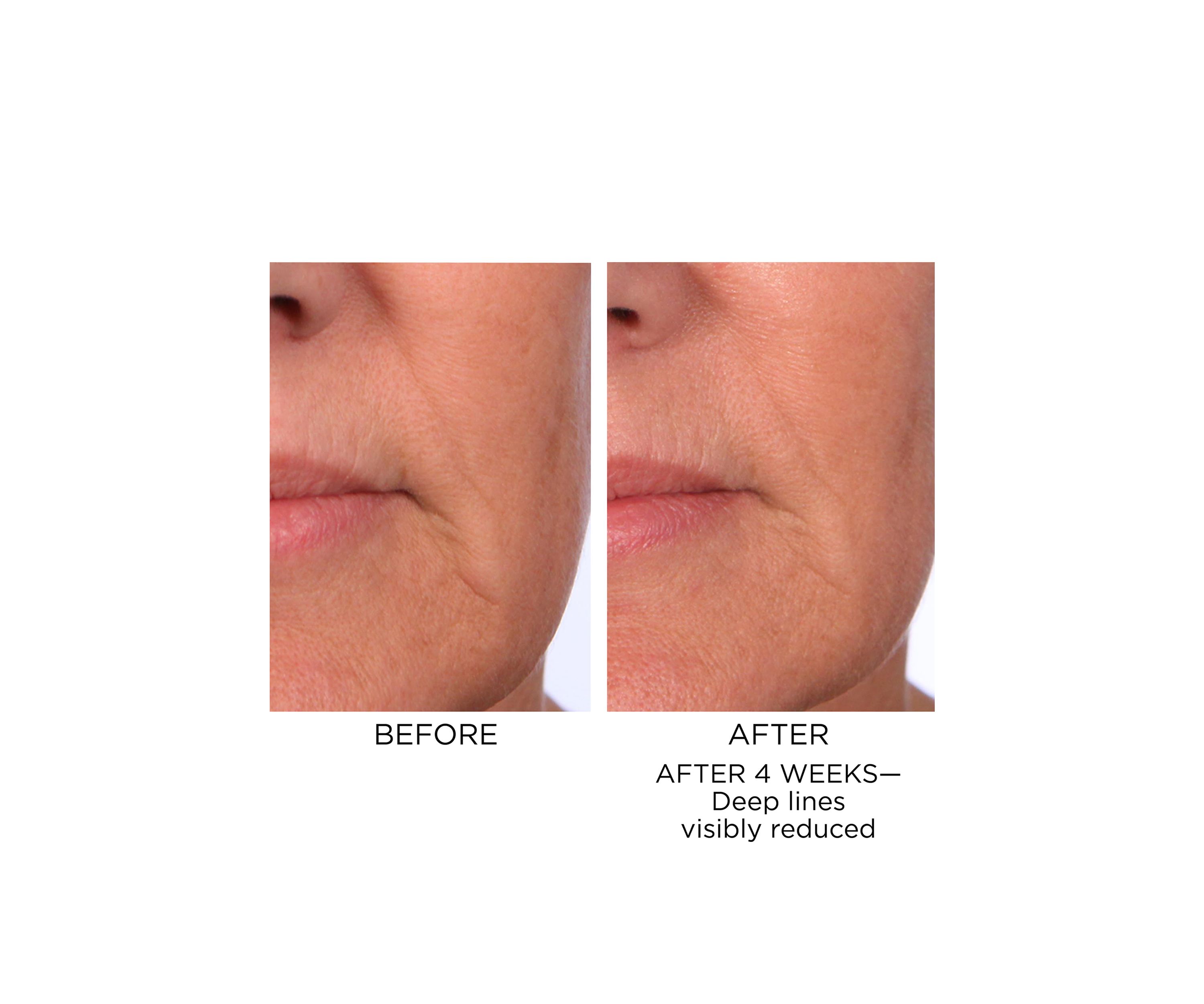 Prevage Progressive Renewal Treatment