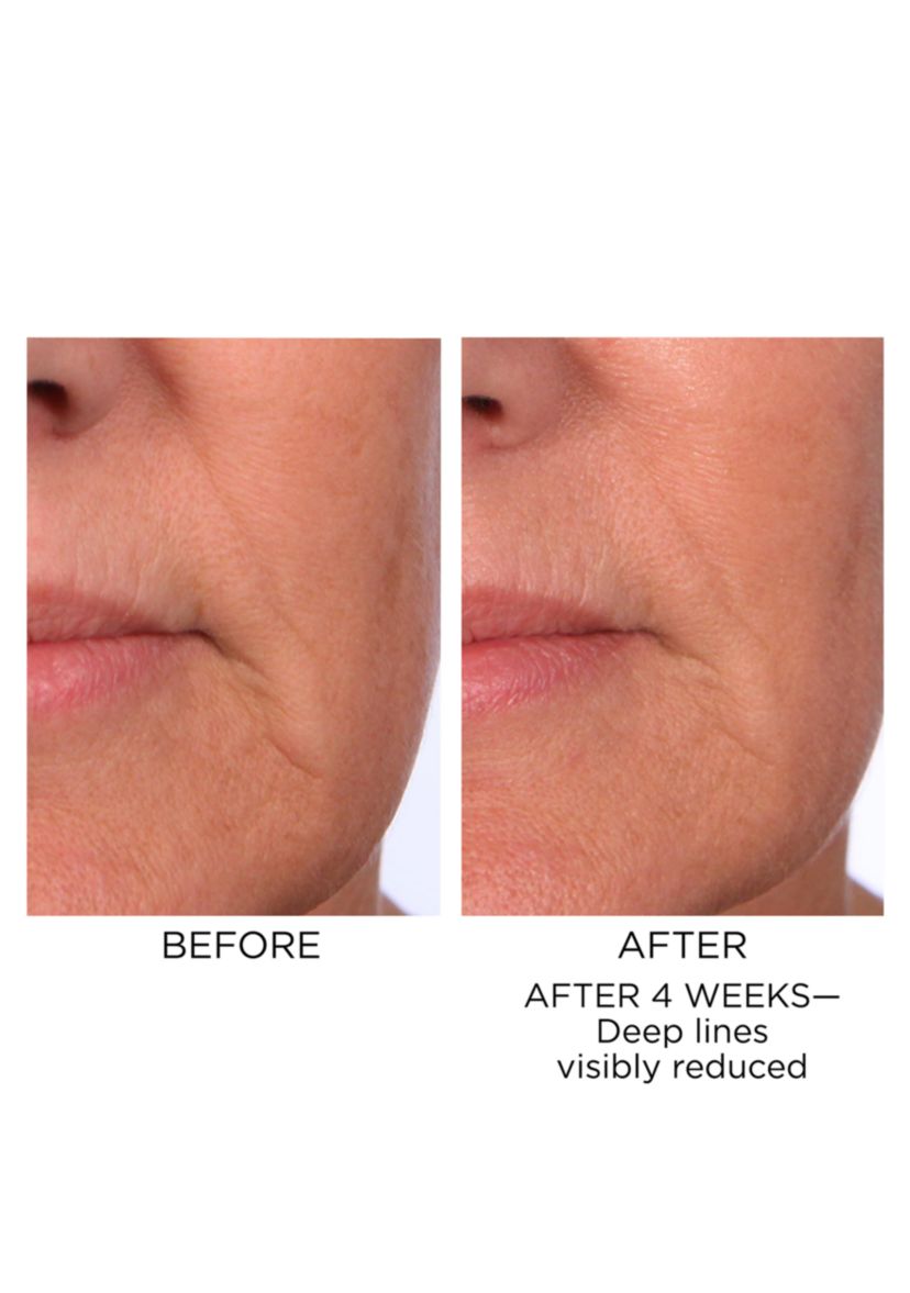 Prevage Progressive Renewal Treatment