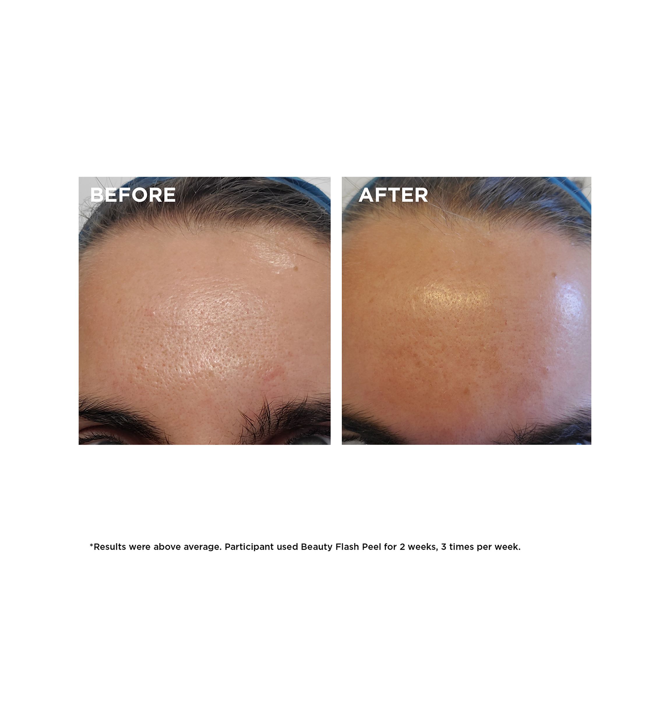 Beauty Flash Peel with BHA & AHA