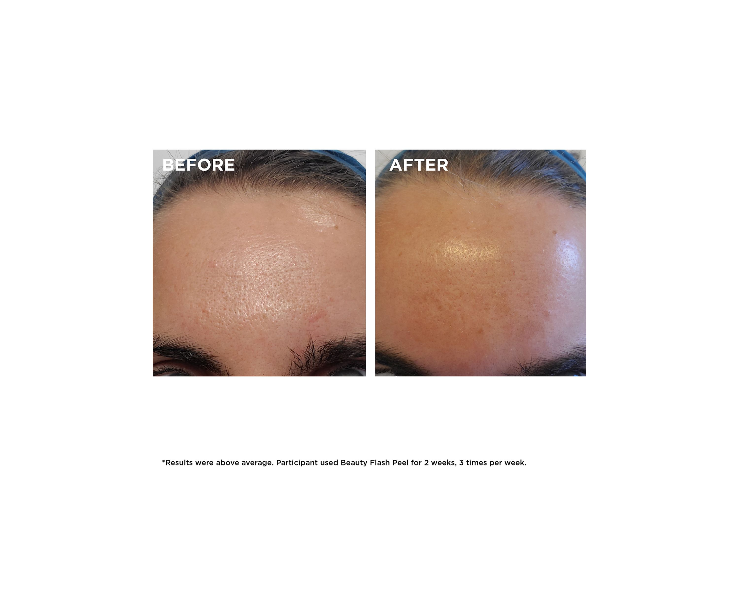 Beauty Flash Peel with BHA & AHA