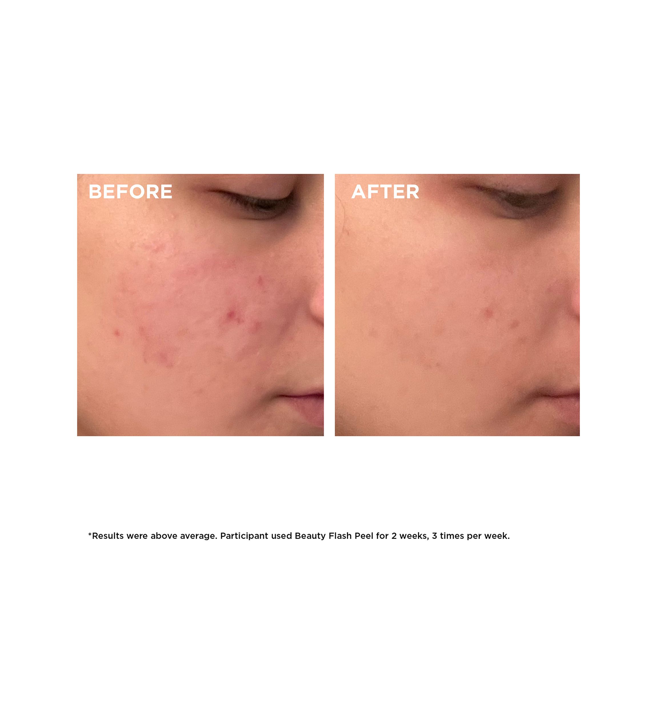 Beauty Flash Peel with BHA & AHA