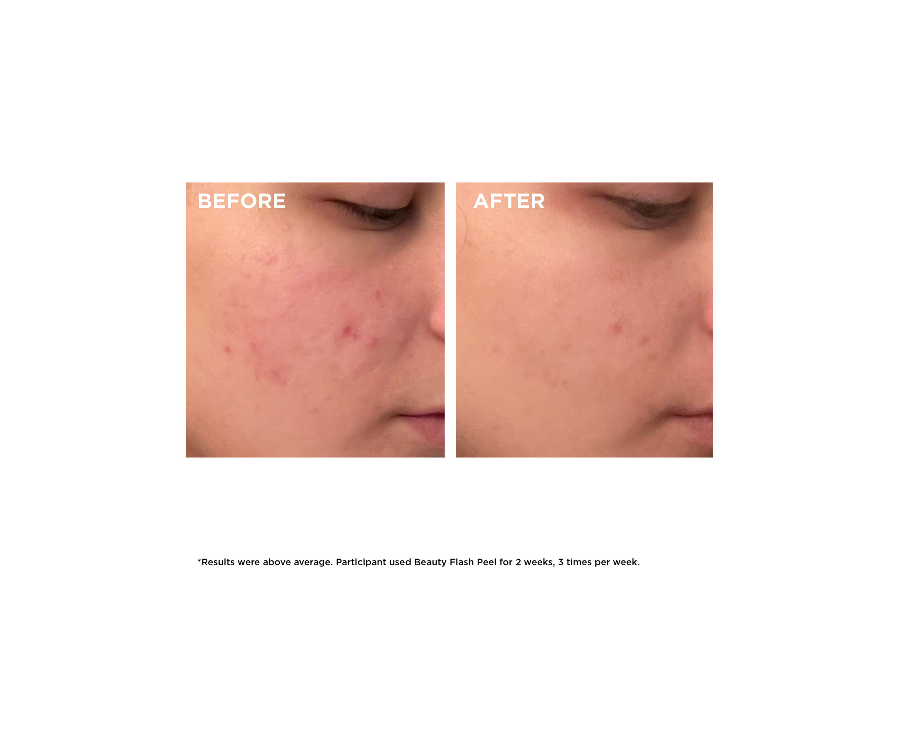Beauty Flash Peel with BHA & AHA